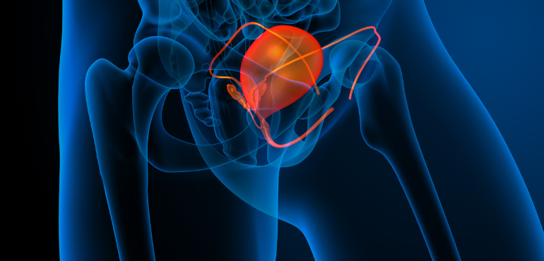 Bladder Stones