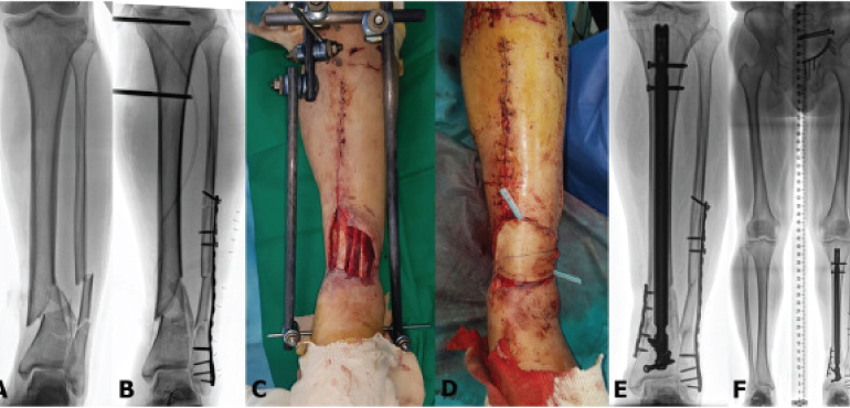 Tibia and Fibula Surgery